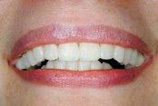 After Results for Cosmetic Dentistry