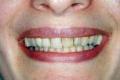 Before Results for Cosmetic Dentistry, Crowns
