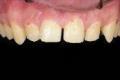 Before Results for Veneers