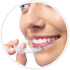 Invisalign tray