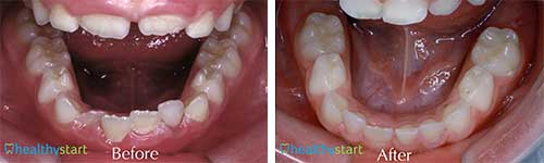 HealthyStart Before and After Photos