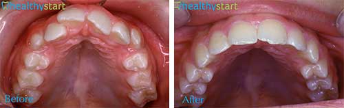 HealthyStart Before and After Photos