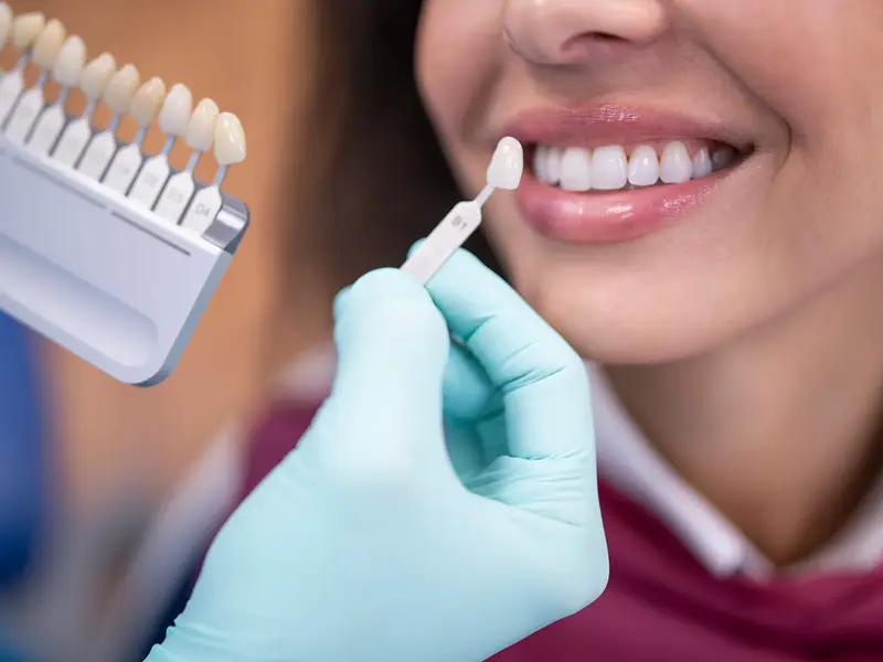 Dentist holding veneer to patient's mouth