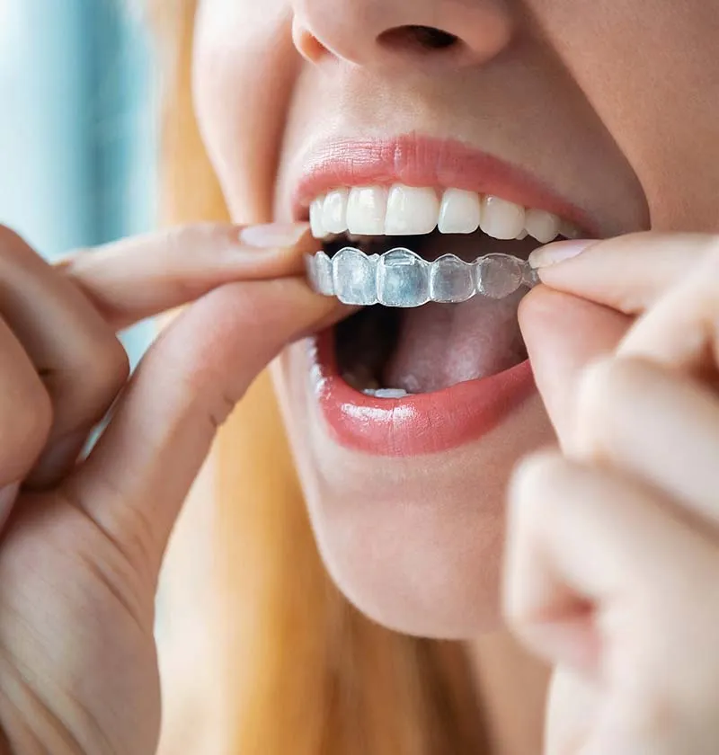 Woman putting on clear aligner